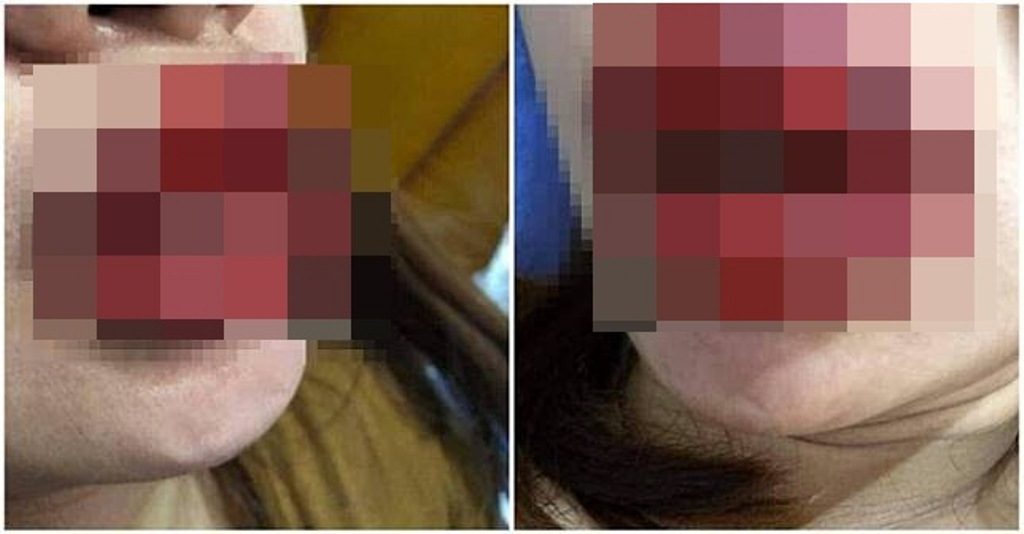 Waspada! Pakai Lipstik Palsu Tiga Hari Berturut-Turut, Bibir Wanita ini Berubah Mengerikan