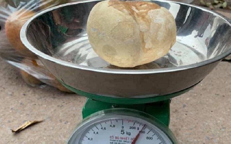 Viral! Wanita Ini Miliki Batu Kandung Kemih Beratnya Nyaris Setengah Kilogram